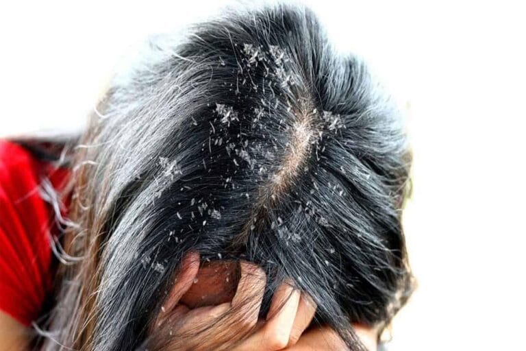 وداعًا للقشرة و الحكة نهائيًا.. وصفة صودا الخبز السحرية لشعر صحي خالٍ من القشرة
