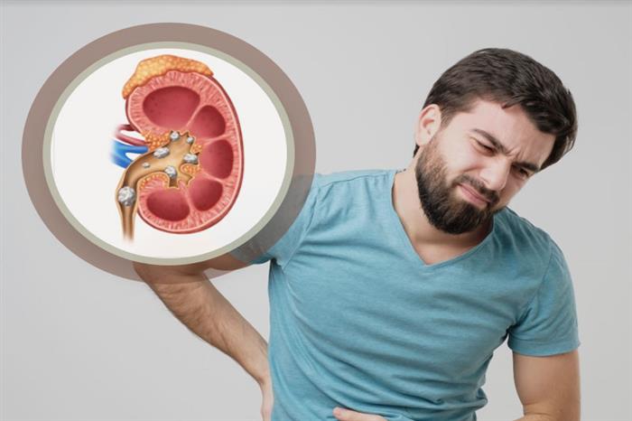 أعراض حصوات الكلى الخفية: لا تتجاهلها.. قد تُنذر بمضاعفات خطيرة! 1 أعراض حصوات الكلى الخفية: لا تتجاهلها.. قد تُنذر بمضاعفات خطيرة!